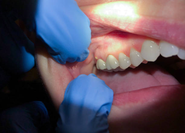 Best Emergency Dental Extractions in Midway South, TX